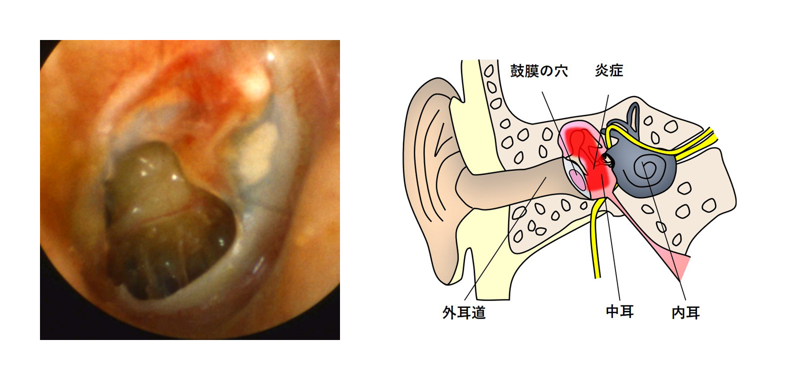 慢性中耳炎に対する鼓室形成術-手術前