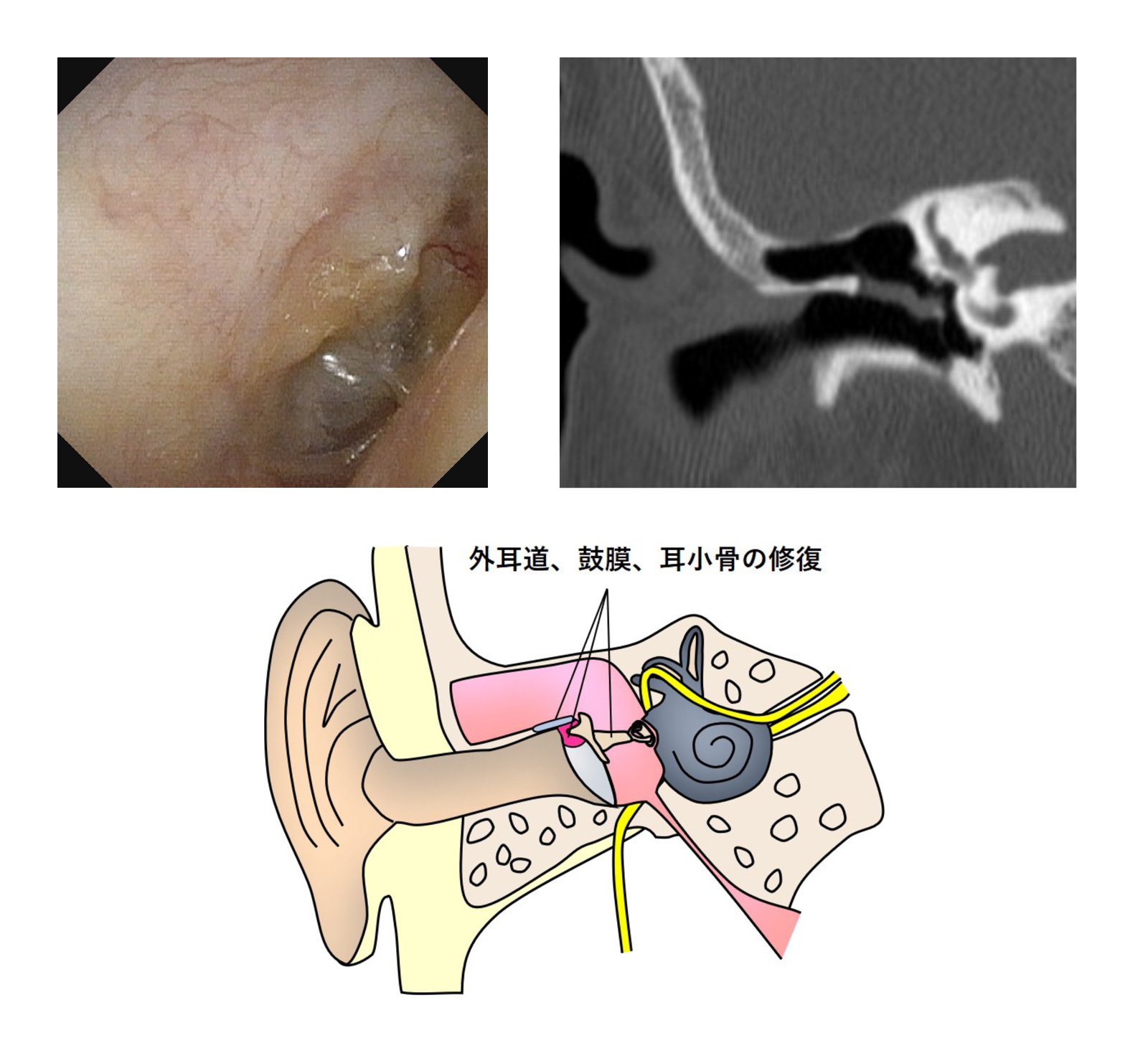 真珠腫性中耳炎に対する鼓室形成術-手術後